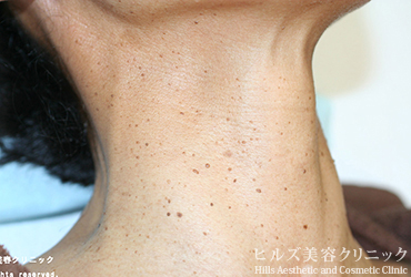 首のイボ右側面施術前