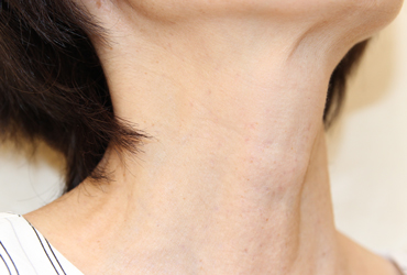 首のイボ左側面施術後