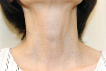 首のイボ正面施術後