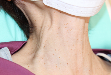 首のイボ左側面施術前