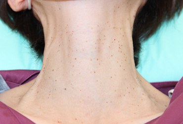 首のイボ正面施術前