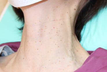 首のイボ右側面施術前