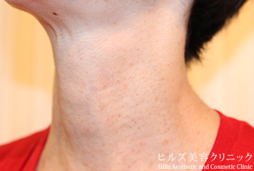 首のイボ左側面1カ月後