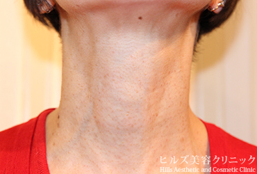 首のイボ正面1カ月後