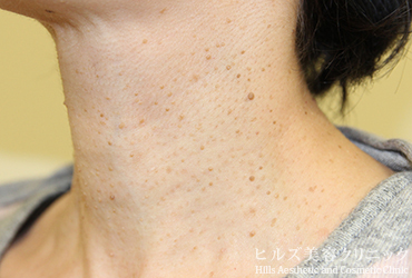 首のイボ左側面施術前