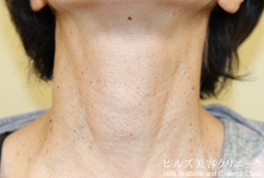 首のイボ正面施術前