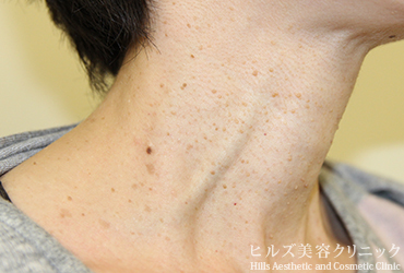 首のイボ右側面施術前