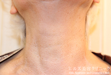 首のイボ正面1カ月後