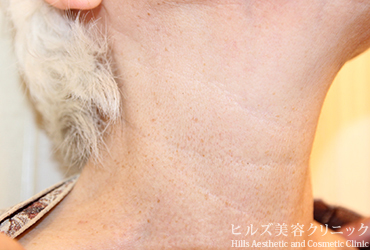 首のイボ右側面1カ月後