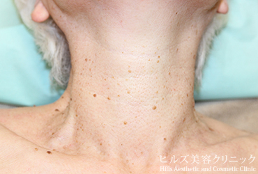 首のイボ正面施術前