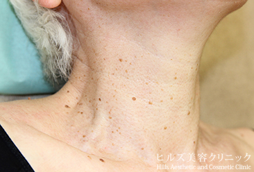 首のイボ右側面施術前