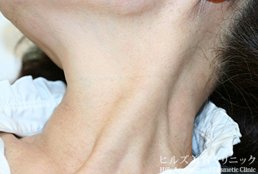 首のイボ右側面6カ月