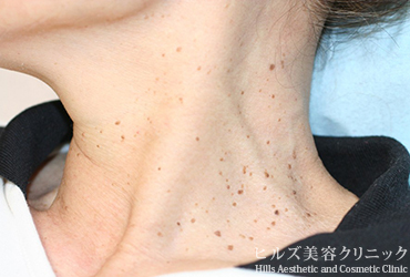 首のイボ右側面施術前