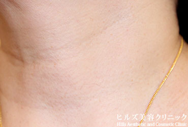 首のイボ左側面2年3.5カ月後