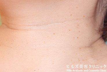 首のイボ左側面施術前