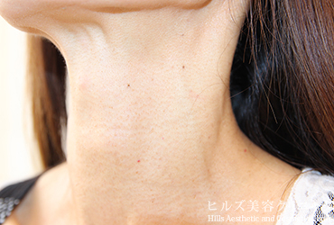 首のイボ左側面施術後