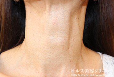 首のイボ正面施術後