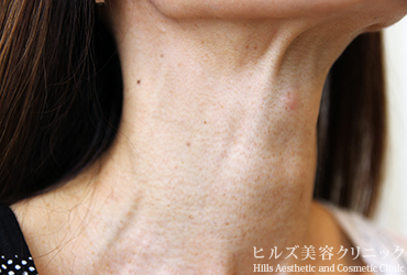 首のイボ右側面1カ月