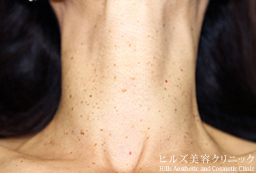 首のイボ正面施術前