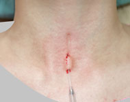 マディソンピアス穴あけ