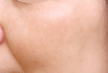 左頬の肝斑術後1カ月