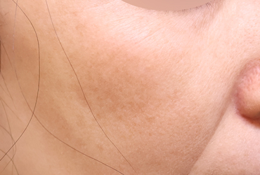 右頬の肝斑術前