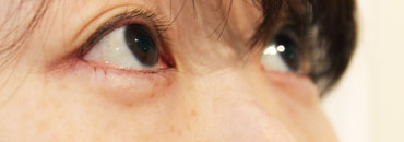 施術前斜め向き