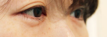 施術前斜め向き