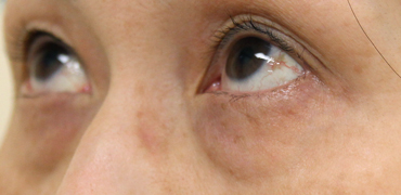 施術前斜め向き