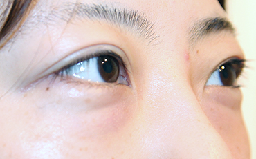 施術前斜め向き