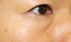 施術前斜め向き