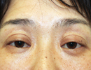 目の上の凹み