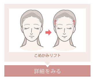 こめかみリフト