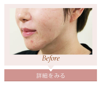 ミドルリフトSMAS法