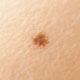 ほくろイメージ