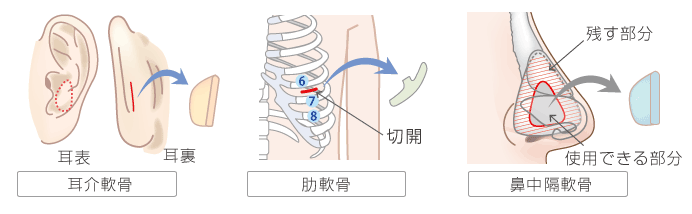 鼻中隔延長術 鼻中隔延長修正 再建術 ヒルズ美容クリニックは神奈川 湘南 藤沢の美容外科 美容皮膚科 形成外科