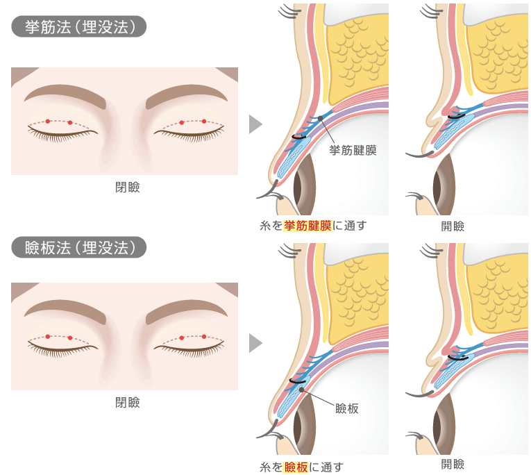 挙筋法（埋没法）と瞼板法（埋没法）の方法図