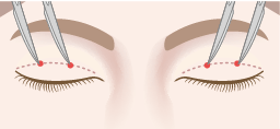 瞼縁から6.5～8mmの位置に片側2か所ずつ（両側4か所）、約1～2mmの皮膚切開