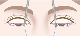 糸を結膜側（まぶたの裏側）から挙筋または瞼板に通す