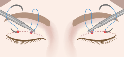 結膜側（まぶたの裏側）の同じ針穴から皮膚側に向かって糸を通す