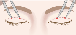 瞼縁から6.5～8mmの位置に片側2か所ずつ（両側4か所）、約1～2mmの皮膚切開
