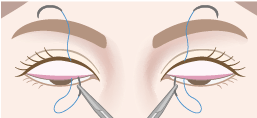 結膜側（まぶたの裏側）から挙筋または瞼板に通す