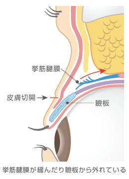 挙筋腱膜が瞼板から緩んだり外れている瞼の断面図