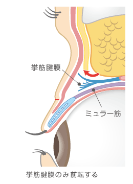 挙筋腱膜を前転した瞼の断面図
