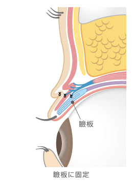 挙筋腱膜を瞼板に固定した瞼の断面図