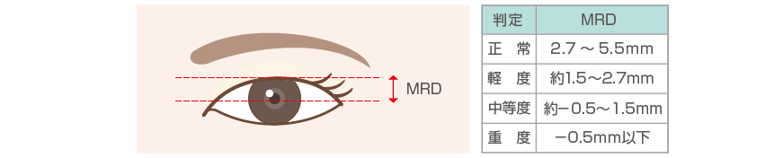 瞼縁角膜反射距離