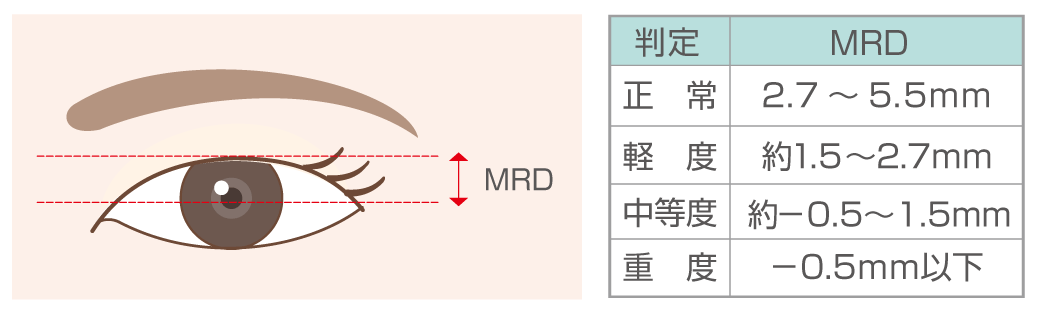 瞼縁角膜反射距離