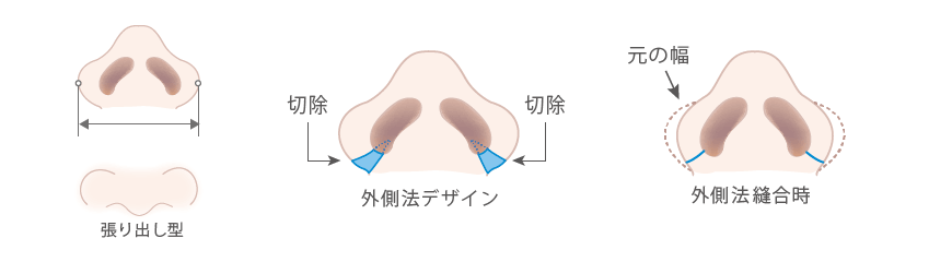 小鼻縮小 鼻翼縮小 ヒルズ美容クリニックは神奈川 湘南 藤沢の美容外科 美容皮膚科 形成外科