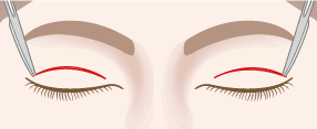 眼窩脂肪除去術＋全切開による重瞼術1正面