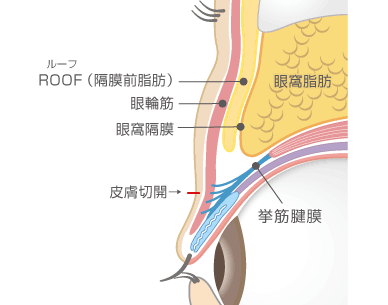 眼窩脂肪除去術＋全切開による重瞼術1断面